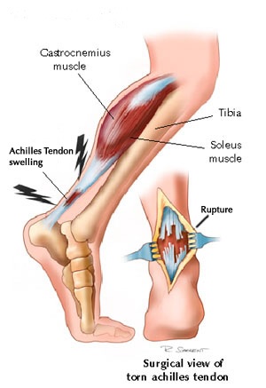 Mild on sale achilles tendonitis